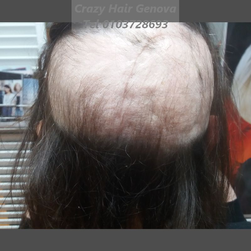 alopecia da extension